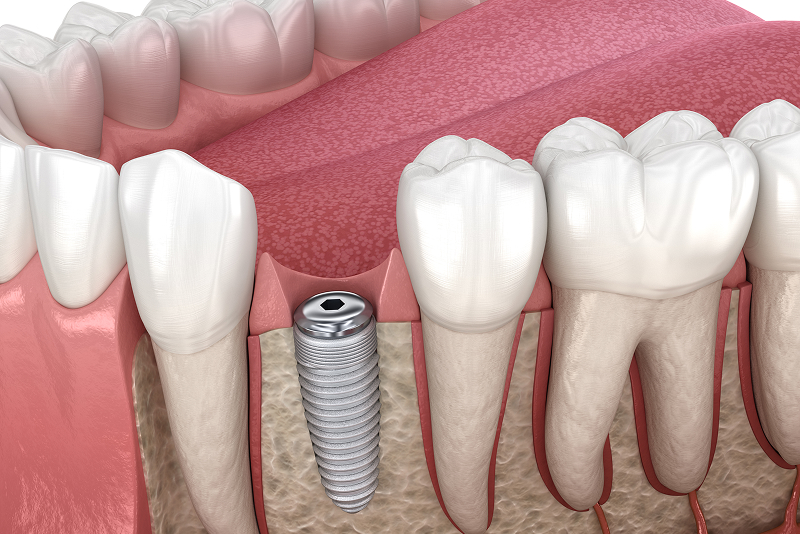 インプラント手術