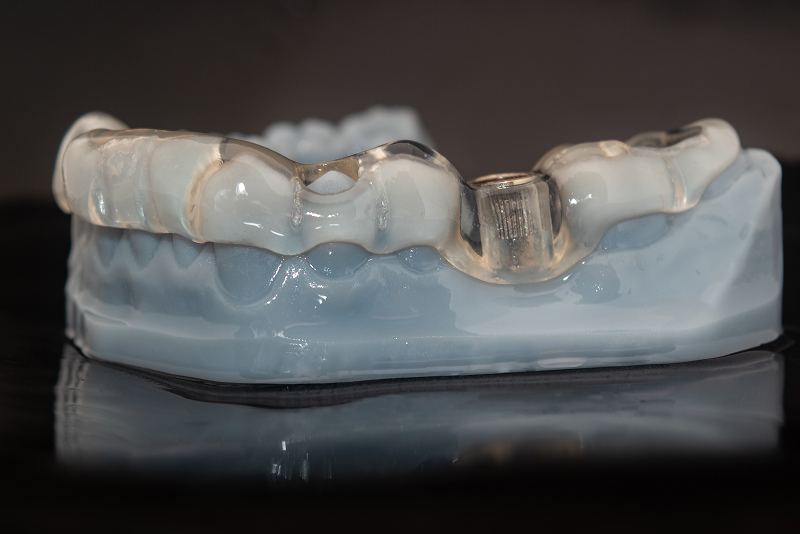 ガイデッドサージェリーにより精密な埋入手術が可能