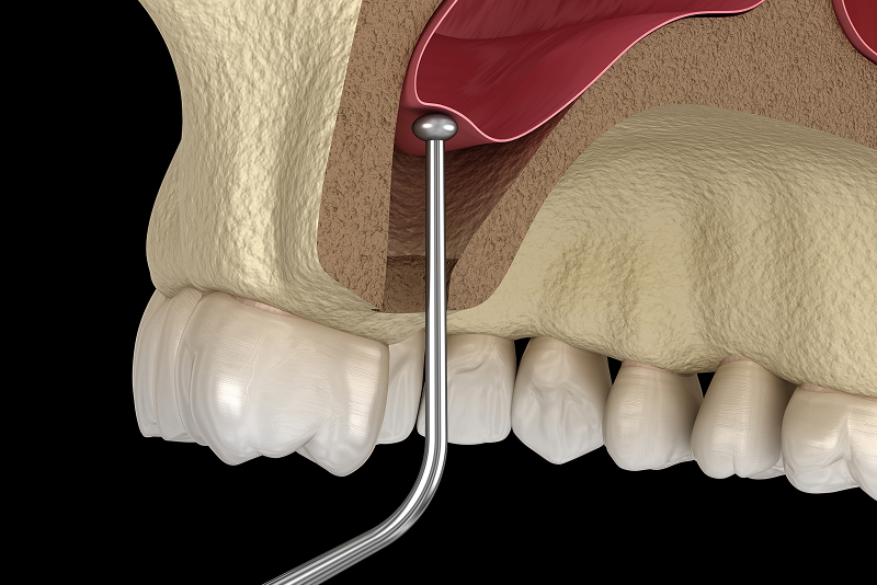 サイナスリフト