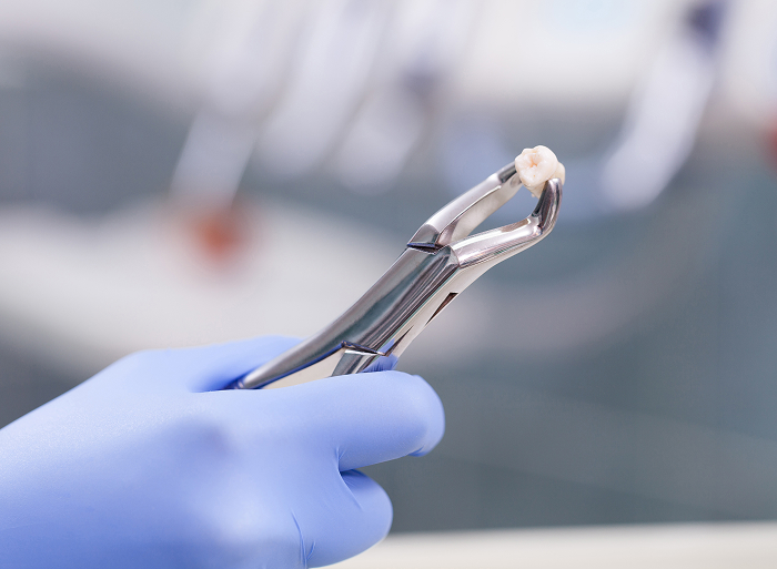 抜歯の経験豊富な歯科医師が担当